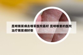 昆明銀屑病去哪家醫(yī)院最好 昆明哪里的醫(yī)院治療銀屑病好些