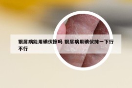 銀屑病能用碘伏擦嗎 銀屑病用碘伏抹一下行不行