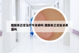 醋酸氯已定治療牛皮癬嗎 醋酸氯已定能殺真菌嗎