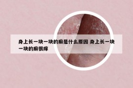 身上長一塊一塊的癬是什么原因 身上長一塊一塊的癬很癢
