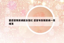重感冒銀屑病就會(huì)變紅 感冒導(dǎo)致銀屑病一夜爆發(fā)