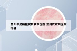 蘭州牛皮癬醫(yī)院皮膚病醫(yī)院 蘭州皮膚病醫(yī)院排名