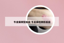 牛皮癬同型反應(yīng) 牛皮癬的同形反應(yīng)