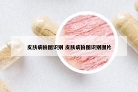 皮膚病拍圖識別 皮膚病拍圖識別圖片