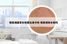 銀屑病國(guó)家補(bǔ)助要社?？▎?銀屑病有補(bǔ)助嗎