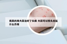 我真的用大蒜治好了頭癬 大蒜可以擦頭皮起什么作用