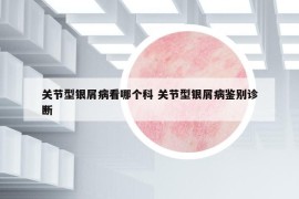 關(guān)節(jié)型銀屑病看哪個(gè)科 關(guān)節(jié)型銀屑病鑒別診斷