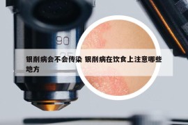 銀削病會不會傳染 銀削病在飲食上注意哪些地方