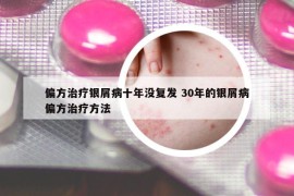 偏方治療銀屑病十年沒復(fù)發(fā) 30年的銀屑病偏方治療方法