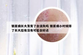 銀屑病長大發(fā)育了會(huì)消失嗎 銀屑病小時(shí)候得了長大后有沒有可能會(huì)好點(diǎn)