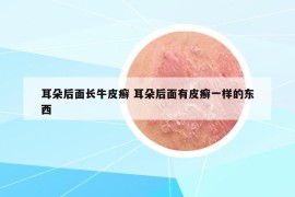 耳朵后面長牛皮癬 耳朵后面有皮癬一樣的東西