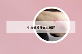 牛皮癬擦什么滋潤好