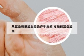 從耳朵哪里放血能治療牛皮癬 皮膚科耳朵放血