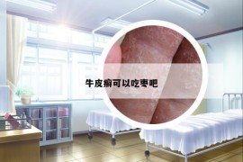 牛皮癬可以吃棗吧