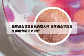 銀屑病會導(dǎo)致鼻息肉增大嗎 銀屑病會導(dǎo)致鼻息肉增大嗎怎么治療