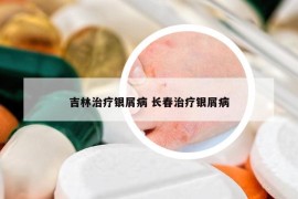 吉林治療銀屑病 長春治療銀屑病