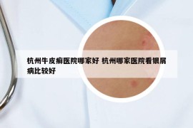 杭州牛皮癬醫(yī)院哪家好 杭州哪家醫(yī)院看銀屑病比較好