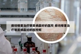 廊坊哪里治療銀屑病最好的醫(yī)院 廊坊哪里治療銀屑病最好的醫(yī)院呢