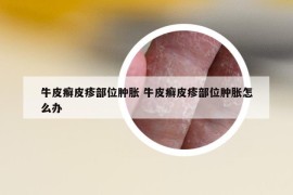 牛皮癬皮疹部位腫脹 牛皮癬皮疹部位腫脹怎么辦