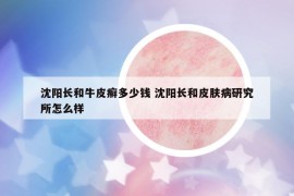 沈陽長和牛皮癬多少錢 沈陽長和皮膚病研究所怎么樣