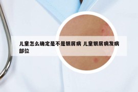 兒童怎么確定是不是銀屑病 兒童銀屑病發(fā)病部位