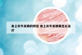 身上長牛皮癬的特征 身上長牛皮膚癬怎么治療
