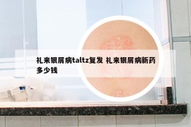 禮來銀屑病taltz復(fù)發(fā) 禮來銀屑病新藥多少錢