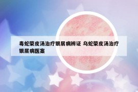 毒蛇榮皮湯治療銀屑病辨證 烏蛇榮皮湯治療銀屑病醫(yī)案