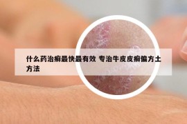 什么藥治癬最快最有效 專治牛皮皮癬偏方土方法