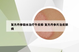 復(fù)方丹參輸水治療牛皮癬 復(fù)方丹參片治皮膚病