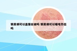 銀屑病可以蓋蠶絲被嗎 銀屑病可以睡電熱毯嗎