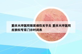 重慶大坪醫(yī)院銀屑病性關(guān)節(jié)炎 重慶大坪醫(yī)院皮膚科專家門診時間表