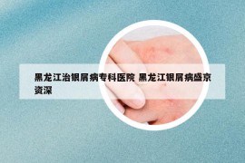 黑龍江治銀屑病?？漆t(yī)院 黑龍江銀屑病盛京資深