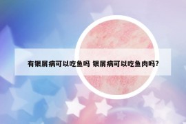 有銀屑病可以吃魚嗎 銀屑病可以吃魚肉嗎?