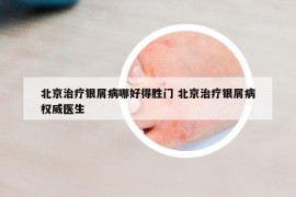 北京治療銀屑病哪好得勝門 北京治療銀屑病權(quán)威醫(yī)生