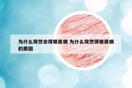 為什么突然會(huì)得銀屑病 為什么突然得銀屑病的原因