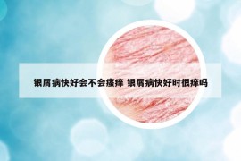 銀屑病快好會(huì)不會(huì)瘙癢 銀屑病快好時(shí)很癢嗎