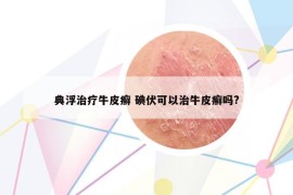 典浮治療牛皮癬 碘伏可以治牛皮癬嗎?