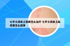 七歲小孩身上張癬怎么治療 七歲小孩身上起疙瘩怎么回事