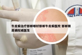 牛皮癬治療邯鄲哪好邯鄲牛皮癬醫(yī)院 邯鄲銀屑病權(quán)威醫(yī)生