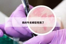 我的牛皮癬愁死我了