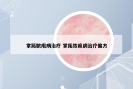 掌跖膿皰病治療 掌跖膿皰病治療偏方