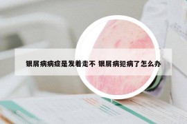 銀屑病病癥是發(fā)著走不 銀屑病犯病了怎么辦