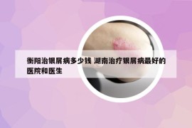 衡陽治銀屑病多少錢 湖南治療銀屑病最好的醫(yī)院和醫(yī)生