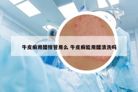 牛皮癬用醋擦管用么 牛皮癬能用醋清洗嗎