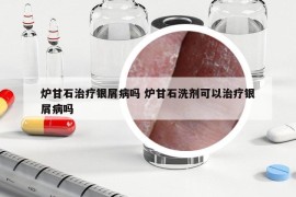 爐甘石治療銀屑病嗎 爐甘石洗劑可以治療銀屑病嗎