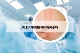 身上長牛皮癬與肝有關(guān)系嗎