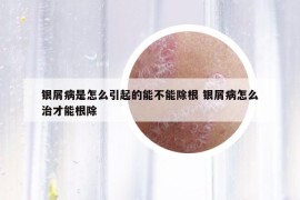 銀屑病是怎么引起的能不能除根 銀屑病怎么治才能根除
