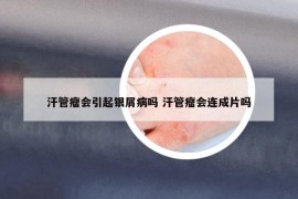汗管瘤會引起銀屑病嗎 汗管瘤會連成片嗎