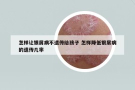 怎樣讓銀屑病不遺傳給孩子 怎樣降低銀屑病的遺傳幾率
